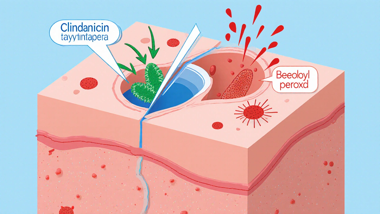 Cleocin Gel vs Alternatives: What Works Best for Acne?